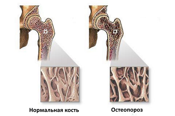 При остеопорозе структура костей сильно ослаблена