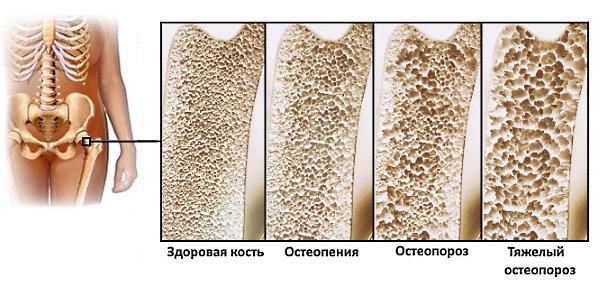 Назначают Теванат при остеопорозе