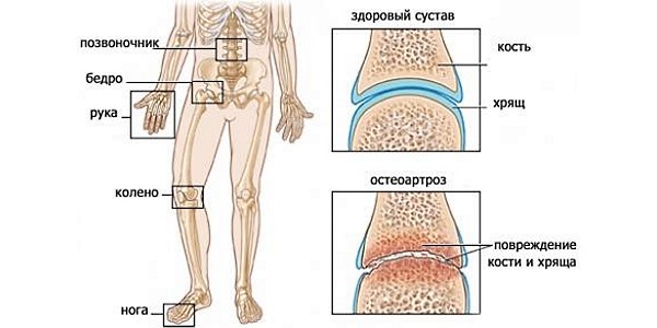 Остеоартроз и остеохондроз - основные причины назначения хондропротектора
