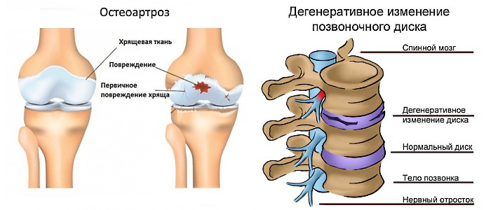 Остеоартроз и дегенеративные изменения в позвоночнике - основные показания к использованию Инъектрана