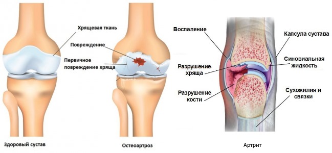 Мелоксикам ДС помогает справиться с остеоартрозом, артритом и спондилоартритом