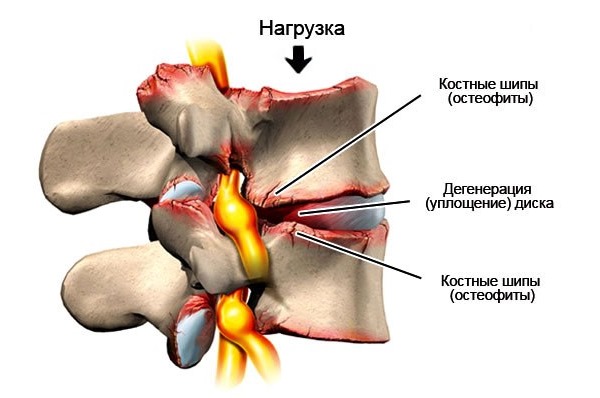 Одно из последствий остеофитов в позвоночнике - защемление нервных корешков
