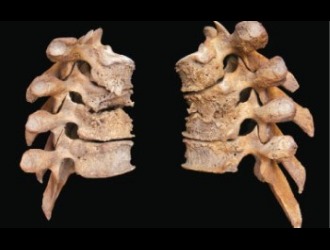 Остеофиты бывают задними, передними, боковыми