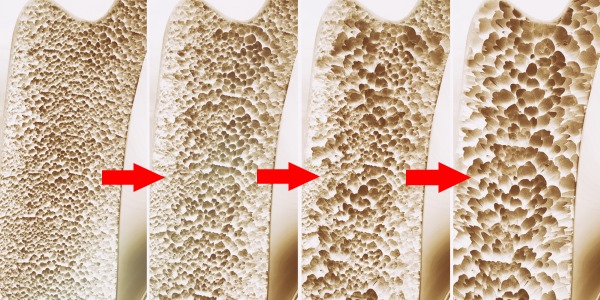 После 35 лет у человека начинается процесс деминерализации костей