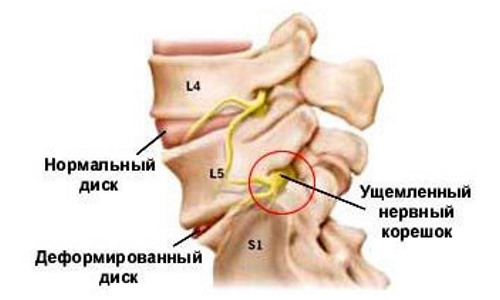 Дорсопатия характеризуется рефлекторным и компрессионным синдромом, которые появляются в связи с защемлением нерва