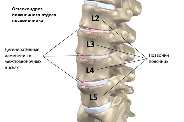 Остеохондроз развивается в следствии больших нагрузок и плохого питания позвоночника