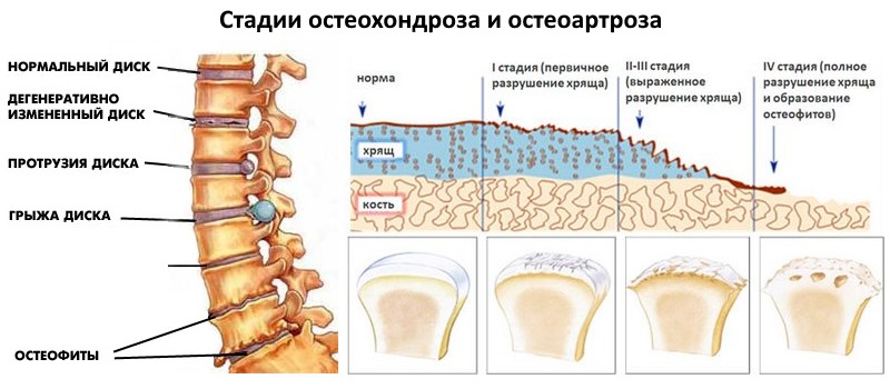 Лечат с помощью Хондроитин Акос остеохондроз и остеоартроз