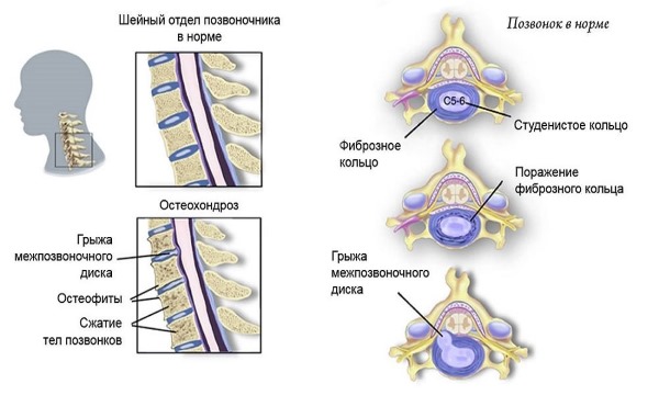 Чаще всего постоянная боль в шее возникает по причине остеохондроза и протрузий дисков