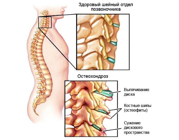 Остеохондроз и грыжи позвоночника являются причинами тянущей боли в спине