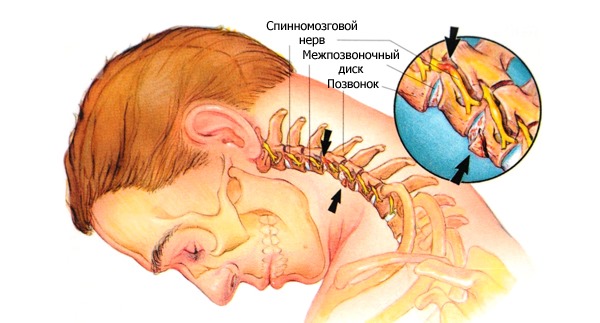 При остеохондрозе 3 степени боль достаточно выражена из-за защемления нервных окончаний