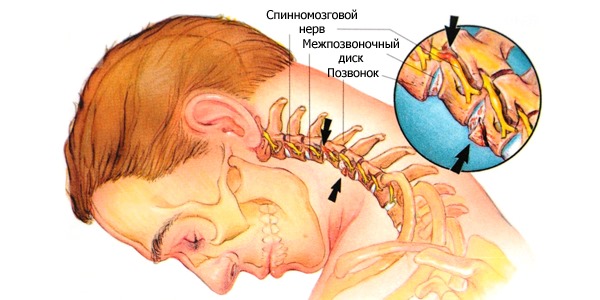 Чаще всего боль в верхней части спины возникают из-за остеохондроза и его последствий