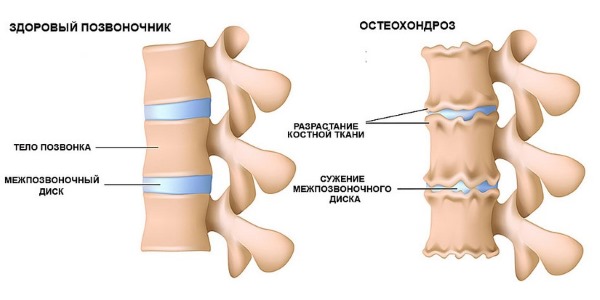 При остеохондрозе происходят необратимые изменения в позвоночнике