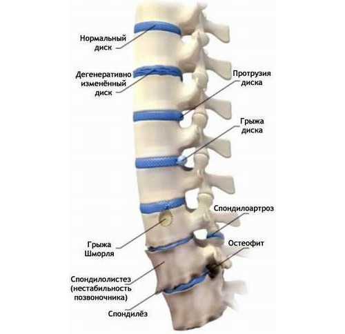 Гимнастика показана для профилактики различных заболеваний позвоночника