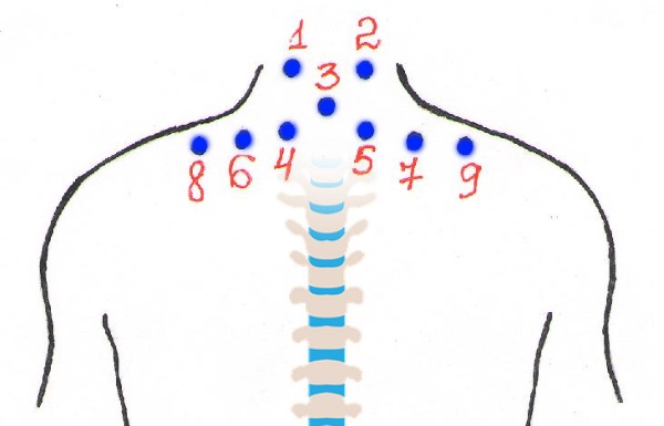 Обратите внимание на точки прикрепления пиявок при остеохондрозе шеи
