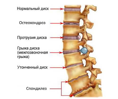 Среди заболеваний позвоночника, которые могут вызывать боль в боку можно выделить дегенеративные изменения в дисках позвонков