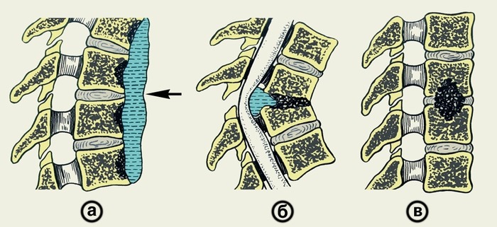 Остеомиелит - инфекционное поражение костной ткани в позвоночнике