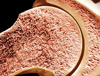 Остеопороз может быть первичным и вторичным