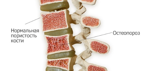 Остеопороз является противопоказанием для проведения транспедикулярной фиксации