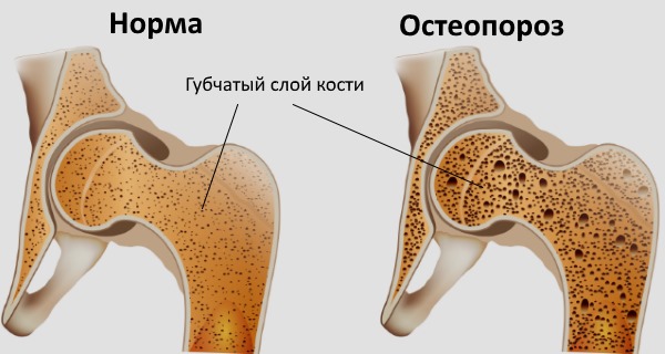 Фосамакс снижает риск возникновения переломов при остеопорозе