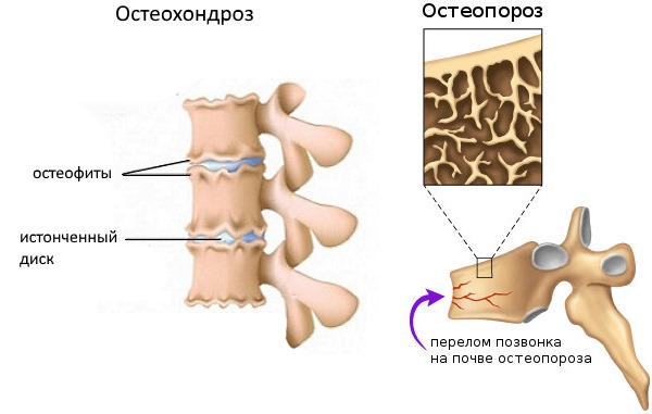 Остеопороз и остеохондроз приводят к нестабильности позвоночника, так как происходит нарушение целостности структур в позвонках