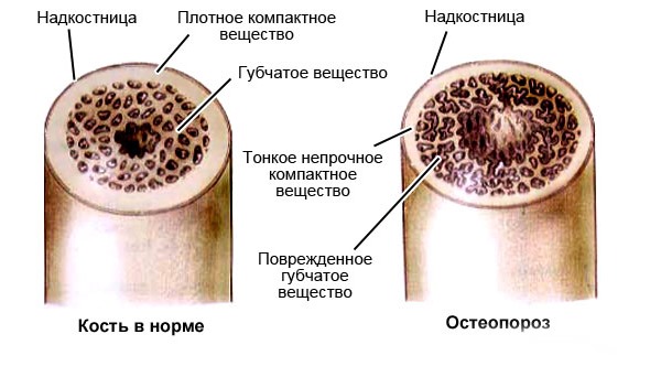 Фосаванс устраняет дефицит кальция в организме