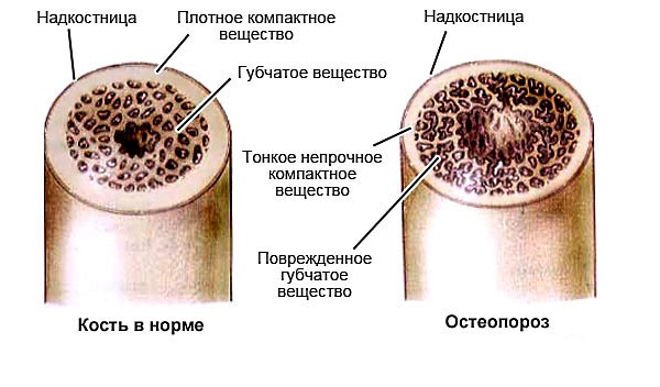 Остеопороз начинает развиваться, когда уменьшается в организме количество кальция и фосфора, что приводит к снижению плотности костей