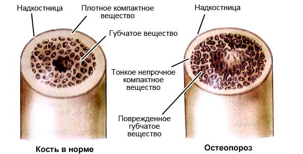 Препарат Алендронат блокирует остеокласты, поэтому его назначают при остеопорозе