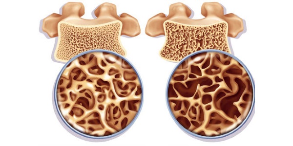Часто перелому крестца подвержены люди с остеопорозом
