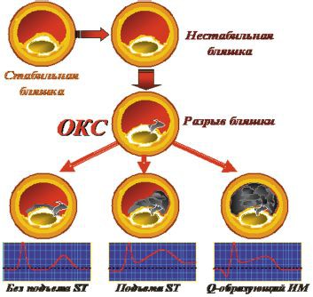 Острый коронарный синдром