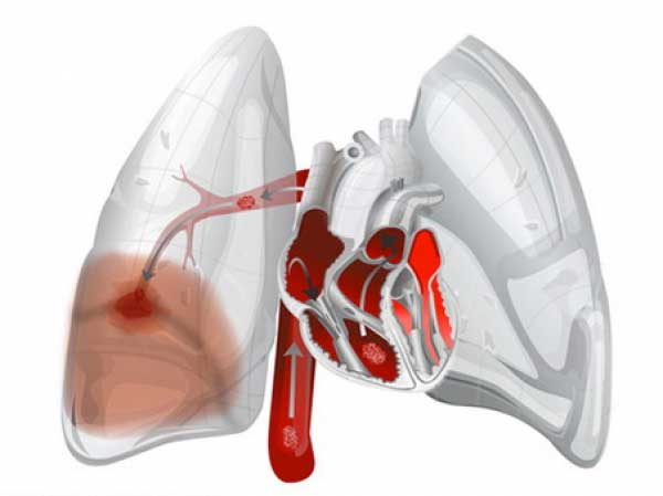 отёк лёгких