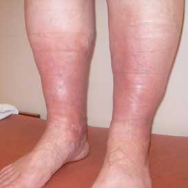 отекшие ноги