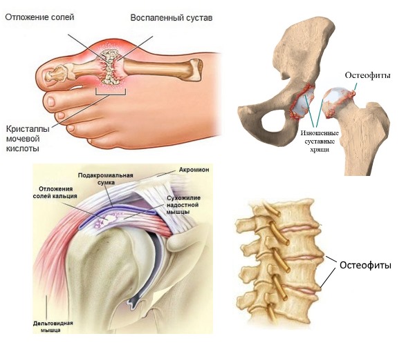 Муравьиный спирт хорошо помогает при дегенеративных патологиях суставов
