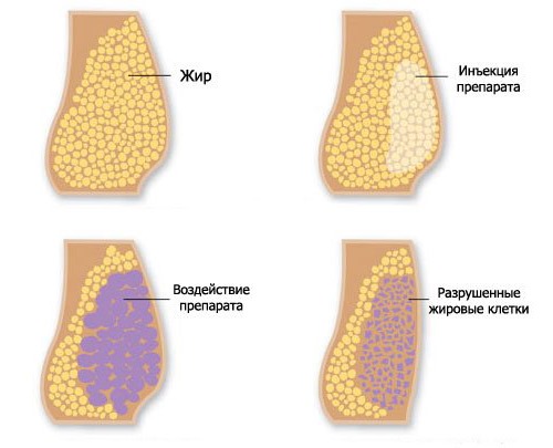 При хирургическом лечении горба на шее вводится препарат для разрушения жировых клеток