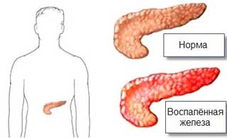 панкреатит