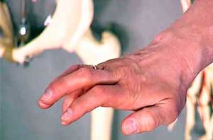 паралич руки