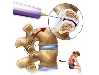 При поясничной грыже делают паравертебральную или артикулярную блокаду