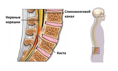 Периневральное образование обычно появляется в поясничном отделе позвоночника