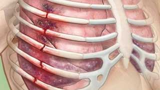 перелом ребер