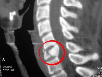 Хирургическое лечение требуется при сильных деформациях позвоночника