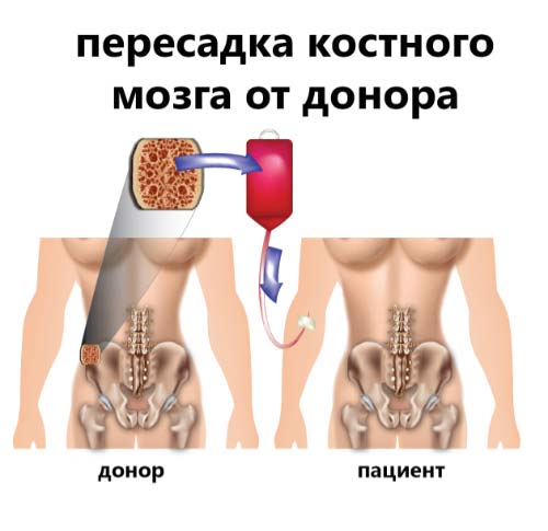 пересадка костного мозга