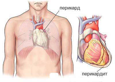 перикардит