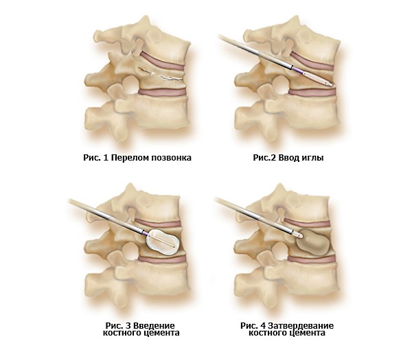 Процесс проведения вертебропластики позвонка