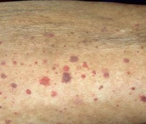 пятна на коже при васкулите