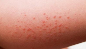красные пятна на коже