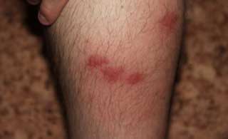 небольшие пятна на ногах