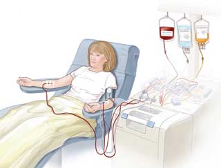 плазмафарез