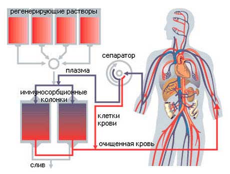 плазмаферез