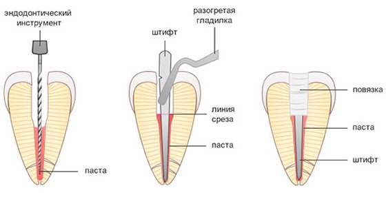 Пломбирование штифтами