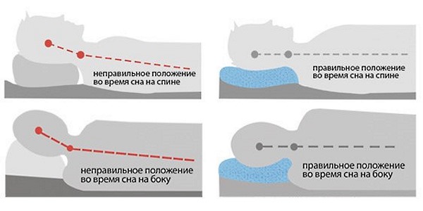 Боль после сна может возникнуть из-за неправильного распределения нагрузки, в следствии чего тело приобретает неправильное положение
