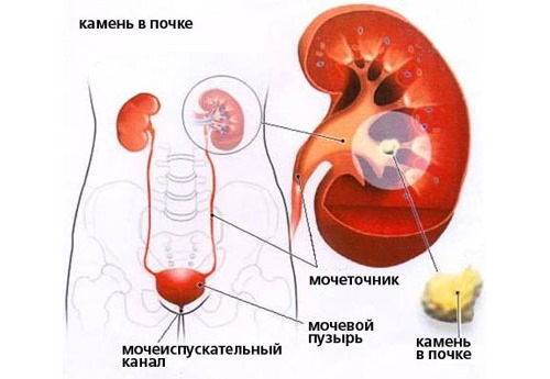 При камнях в почках боль обычно локализуется с правой стороны спины